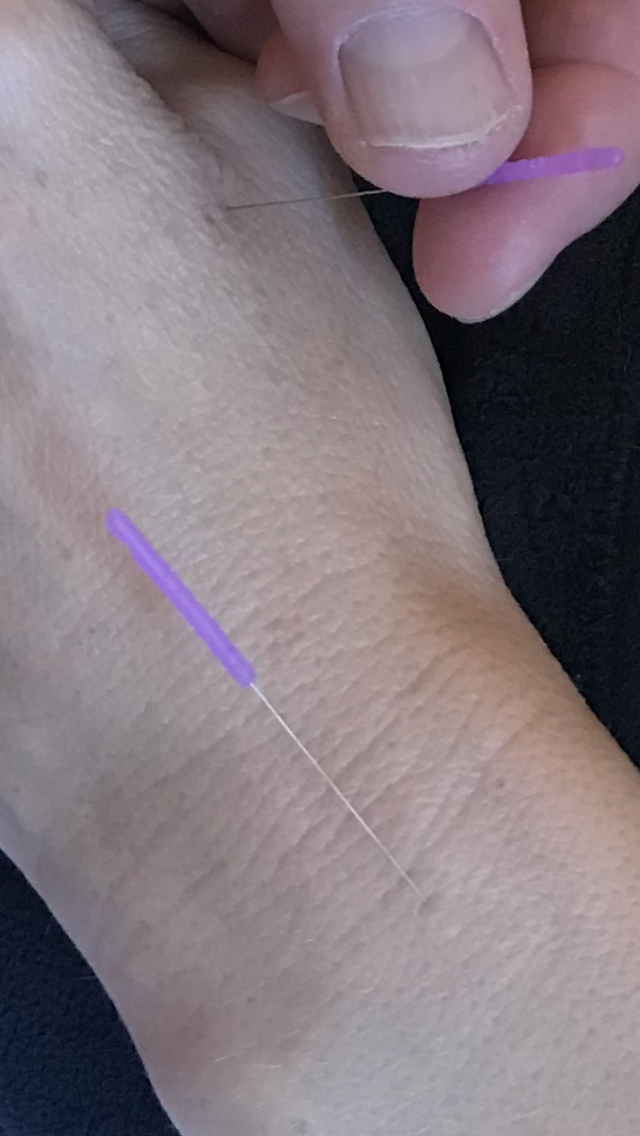 Acupuncture Treatment Manassas